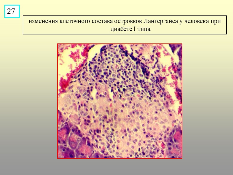 изменения клеточного состава островков Лангерганса у человека при диабете I типа 27